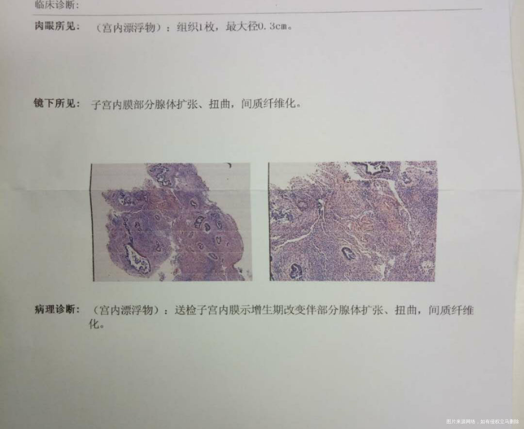 宫腔粘连,做的宫腔镜检查报告,