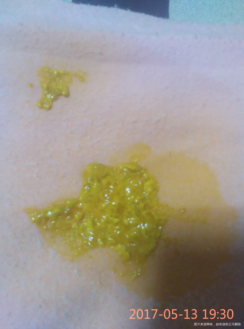 有图慎入,月子里的宝宝拉水样大便