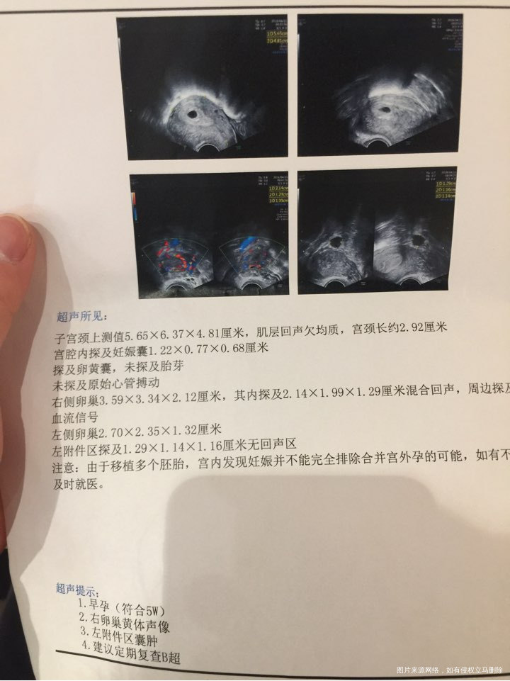 移植后第21天B超结果