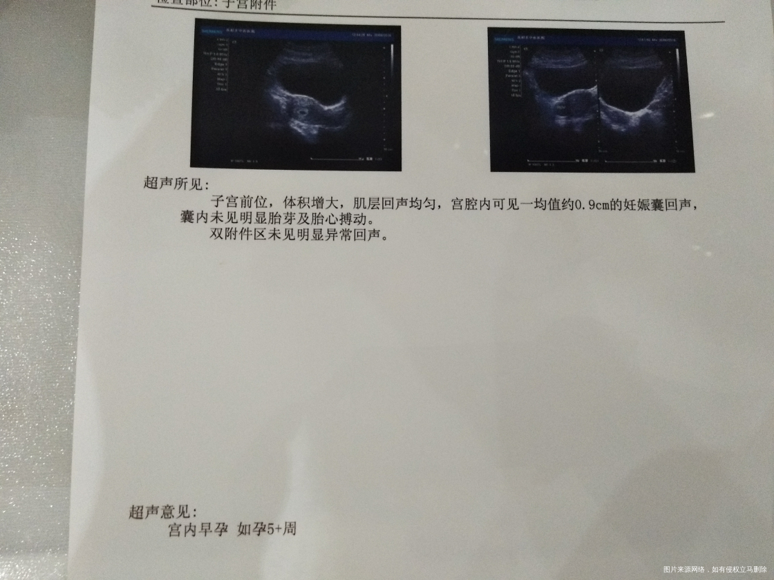 孕酮低,这种情况能保住吗