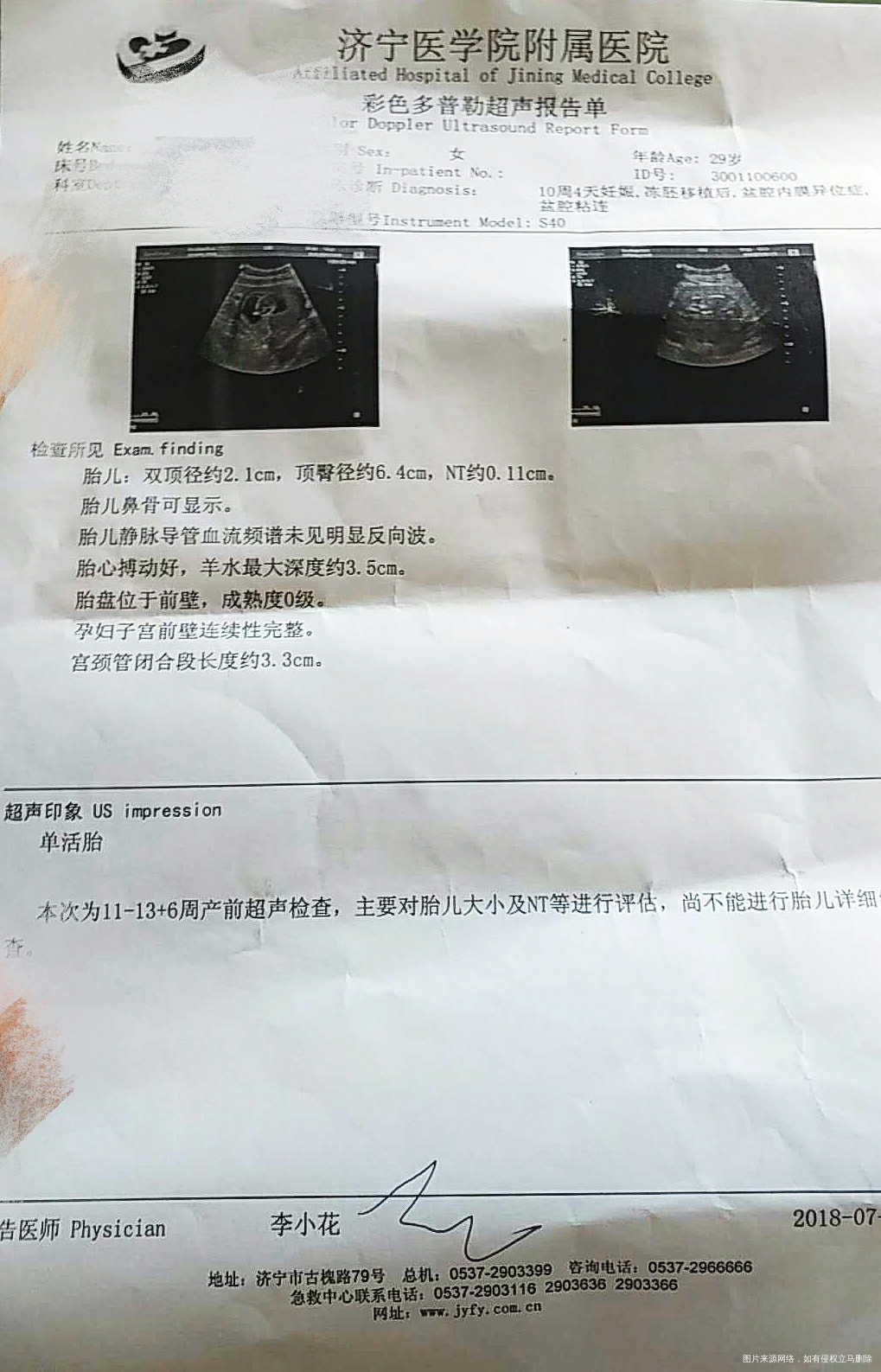 麻烦医生给看看 NT报告的数值 谢谢