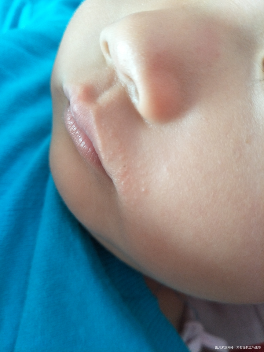 宝宝这段时间嘴巴四周长的这是什么啊。