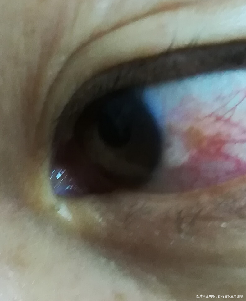 眼睛出血与妇科有关系吗?