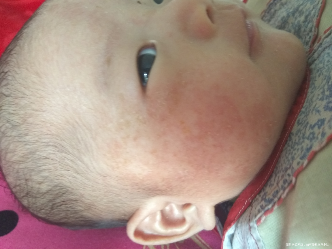 医生帮忙看看这是湿疹吗?怎么办?