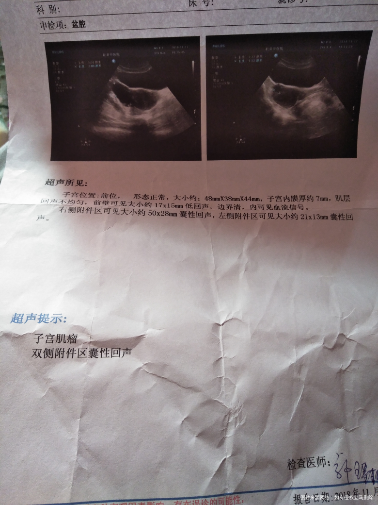 附件一直有囊肿,没办法查卵泡