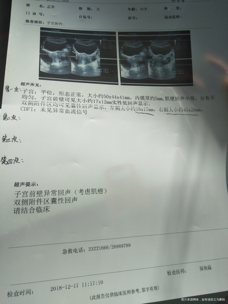 附件囊肿,今天去复查希望给建议