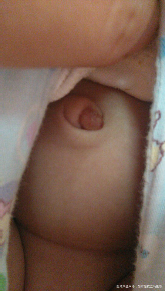 50天的宝宝肚脐长个肉团是脐茸吗?