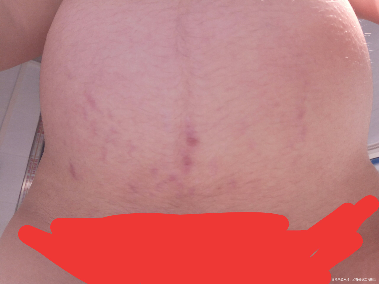 肚子一直挺干净的,前天晚上痒忍不住抓了一下,有会看男女的宝妈吗