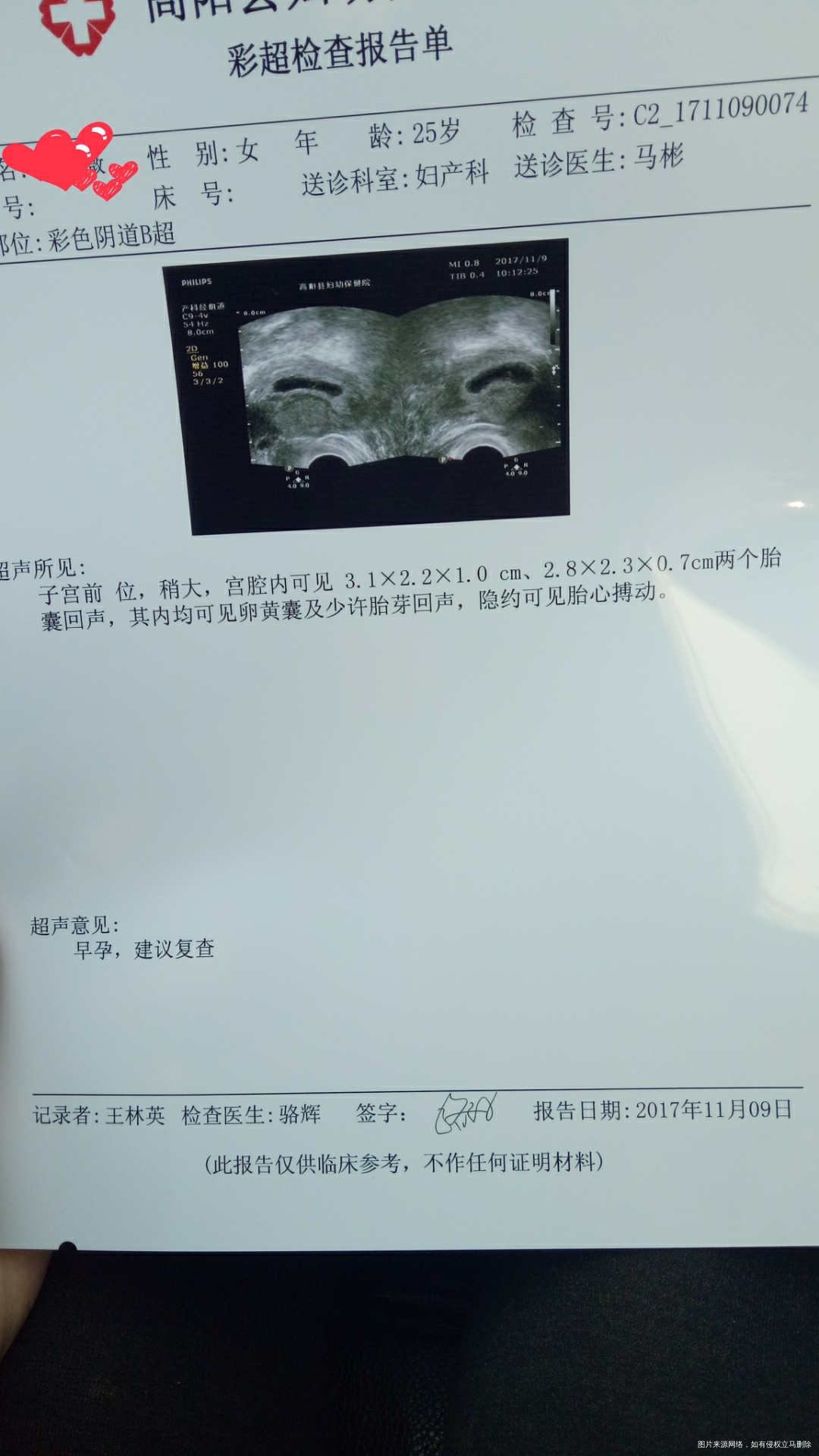 今天移植第二十四天,做了个b超