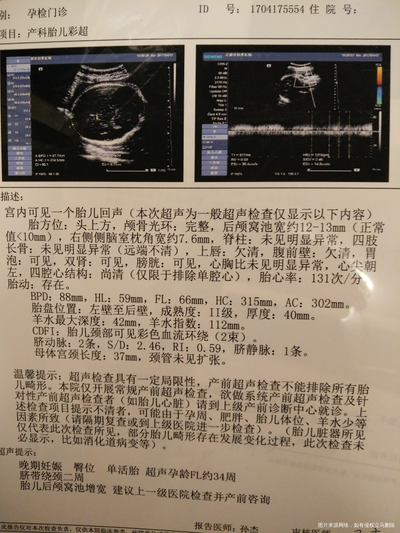 胎儿可能脑积水怎么办