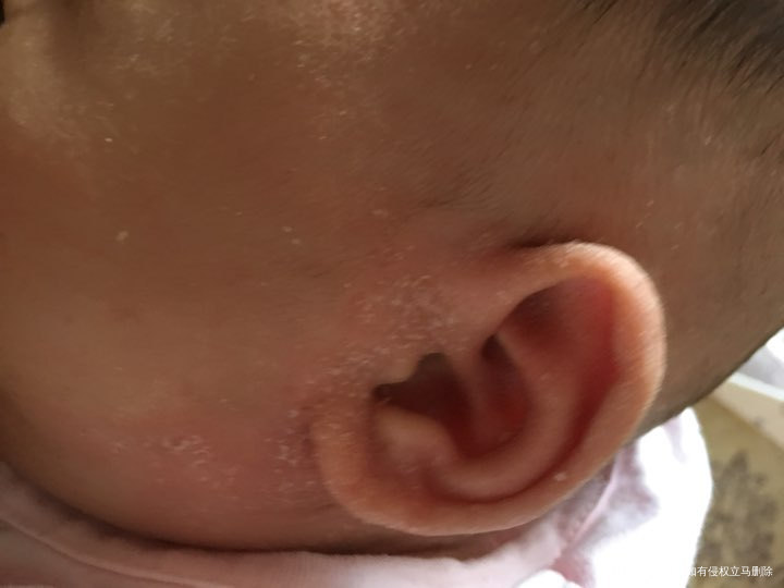 请医生帮忙看看。我家宝宝耳朵是怎么回事
