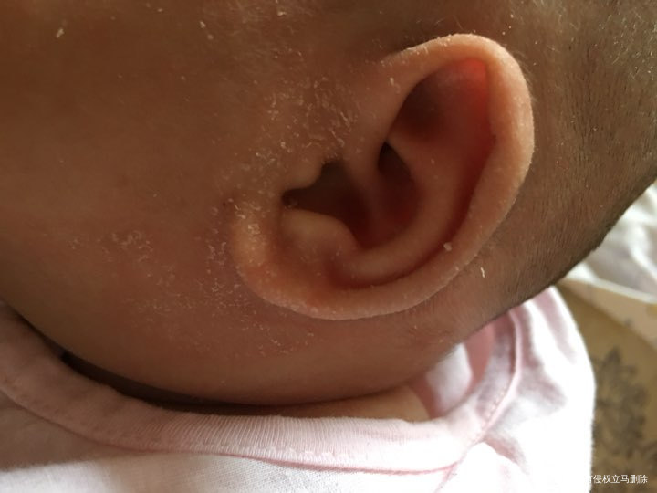 请医生帮忙看看。我家宝宝耳朵是怎么回事