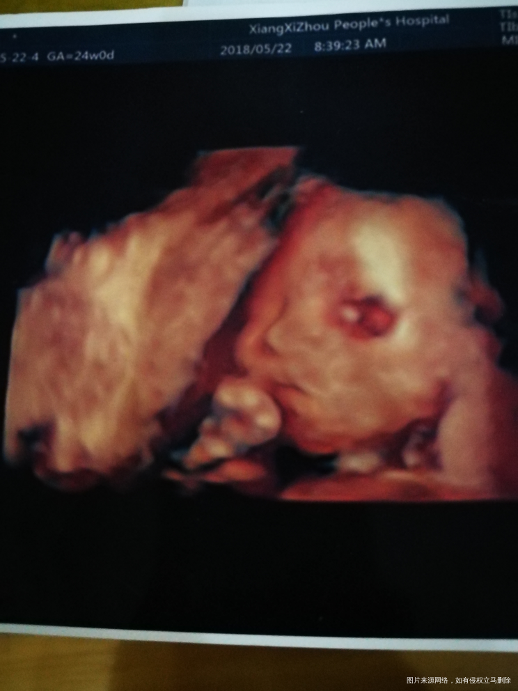 麻烦医生帮忙看看四维结果