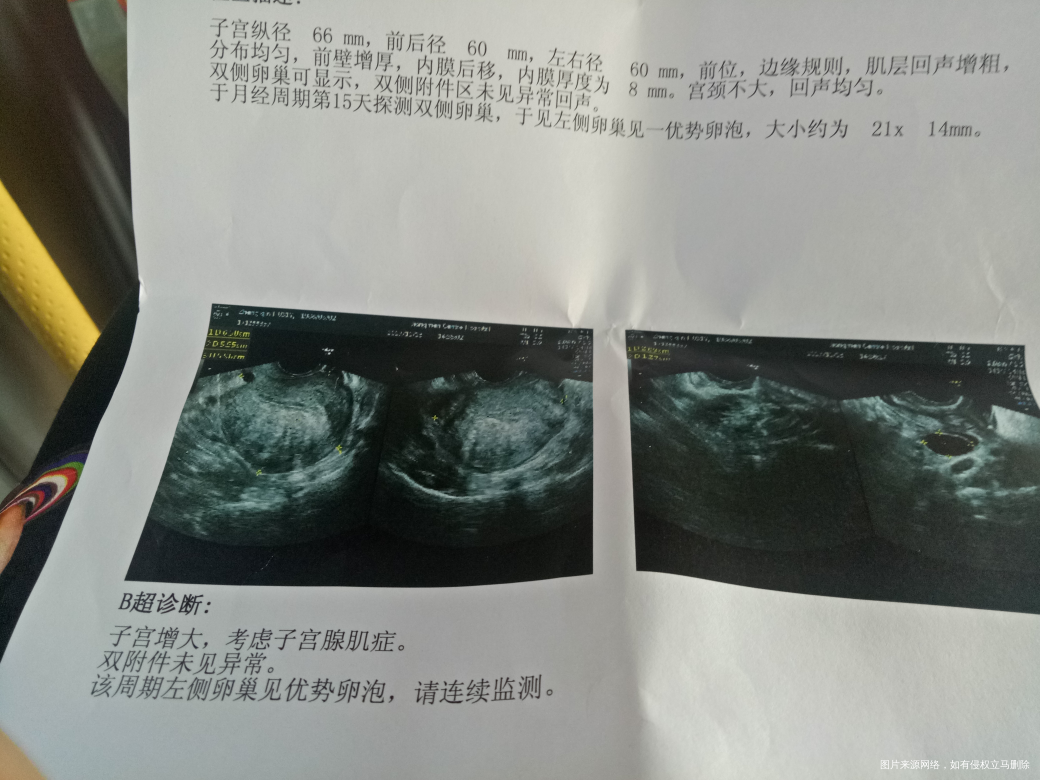 输卵管左边伞部粘连,右边好,左边排卵可以要孩子吗