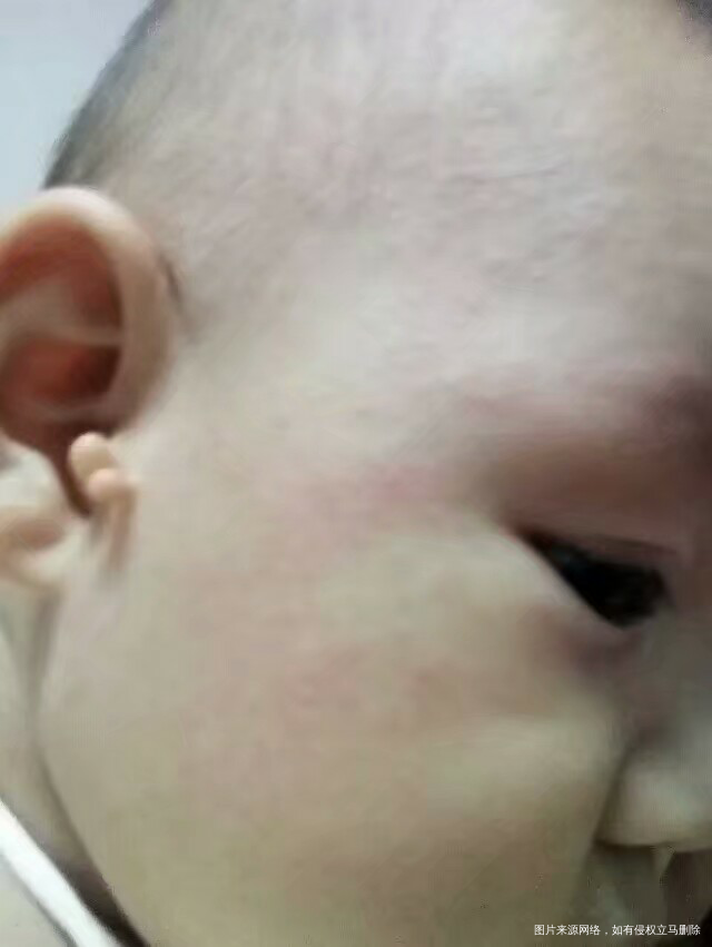 《我的育儿心得》记宝宝的第一次发烧