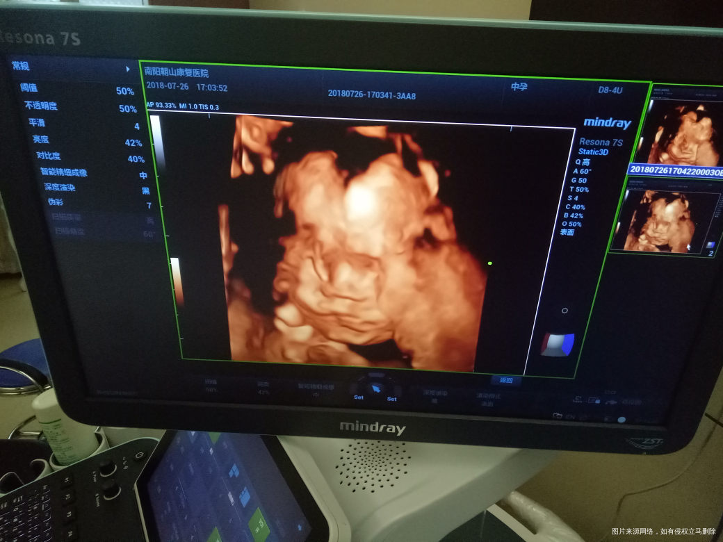 二胎四维一次通过,健康宝宝