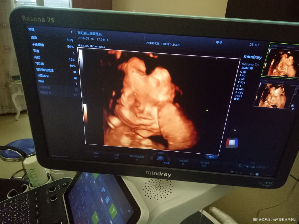 二胎四维一次通过,健康宝宝