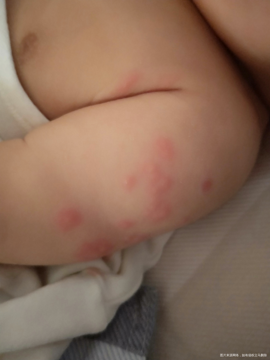 三个月宝宝手臂上有红点