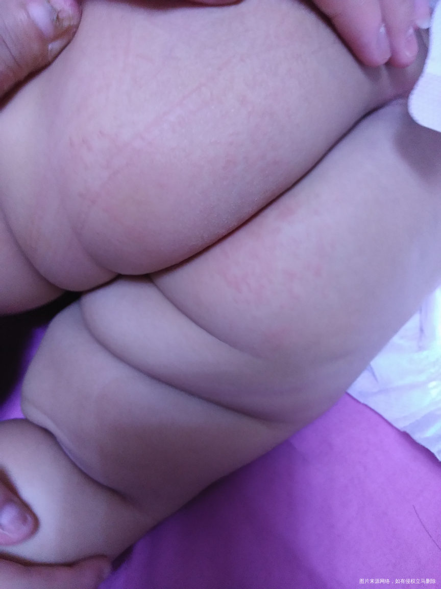 你好,麻烦问下医生,宝宝这个是不是湿疹?