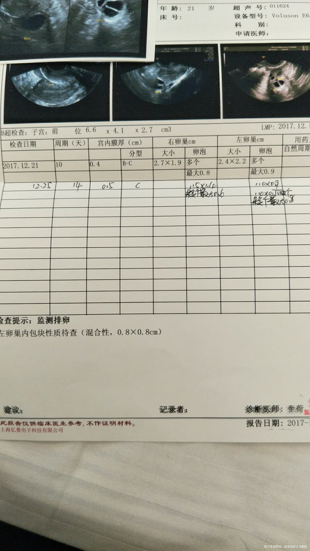 多囊卵巢综合症促排卵中,