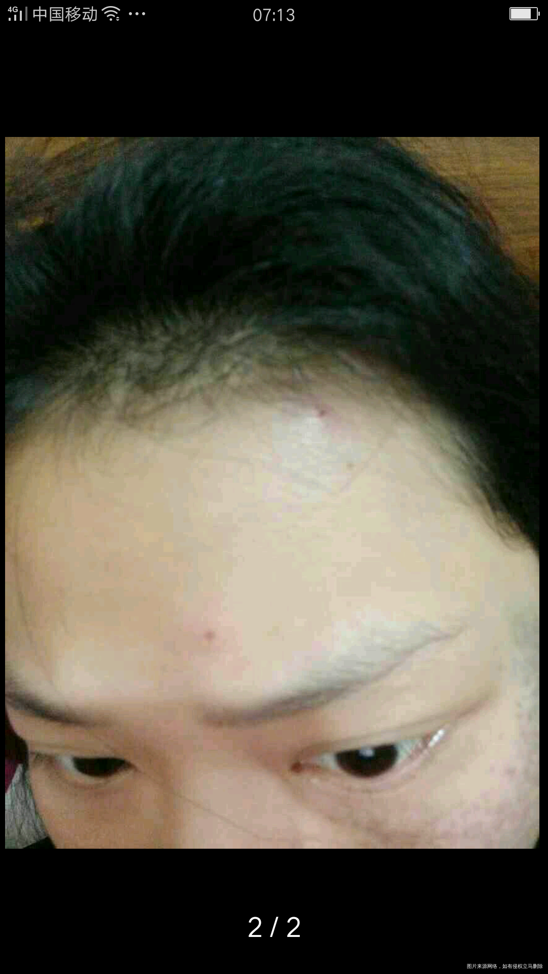 怀孕2个多月发现脸上长了几个痘痘