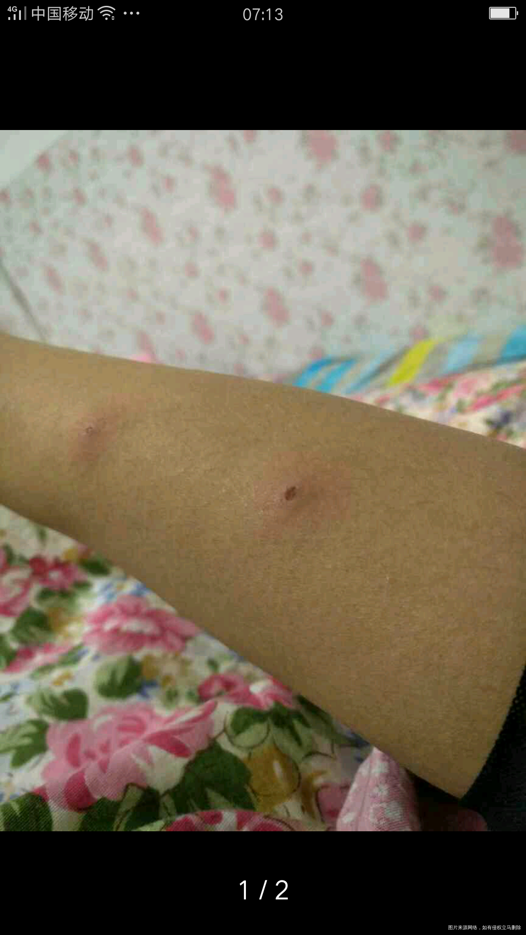 怀孕2个多月发现脸上长了几个痘痘