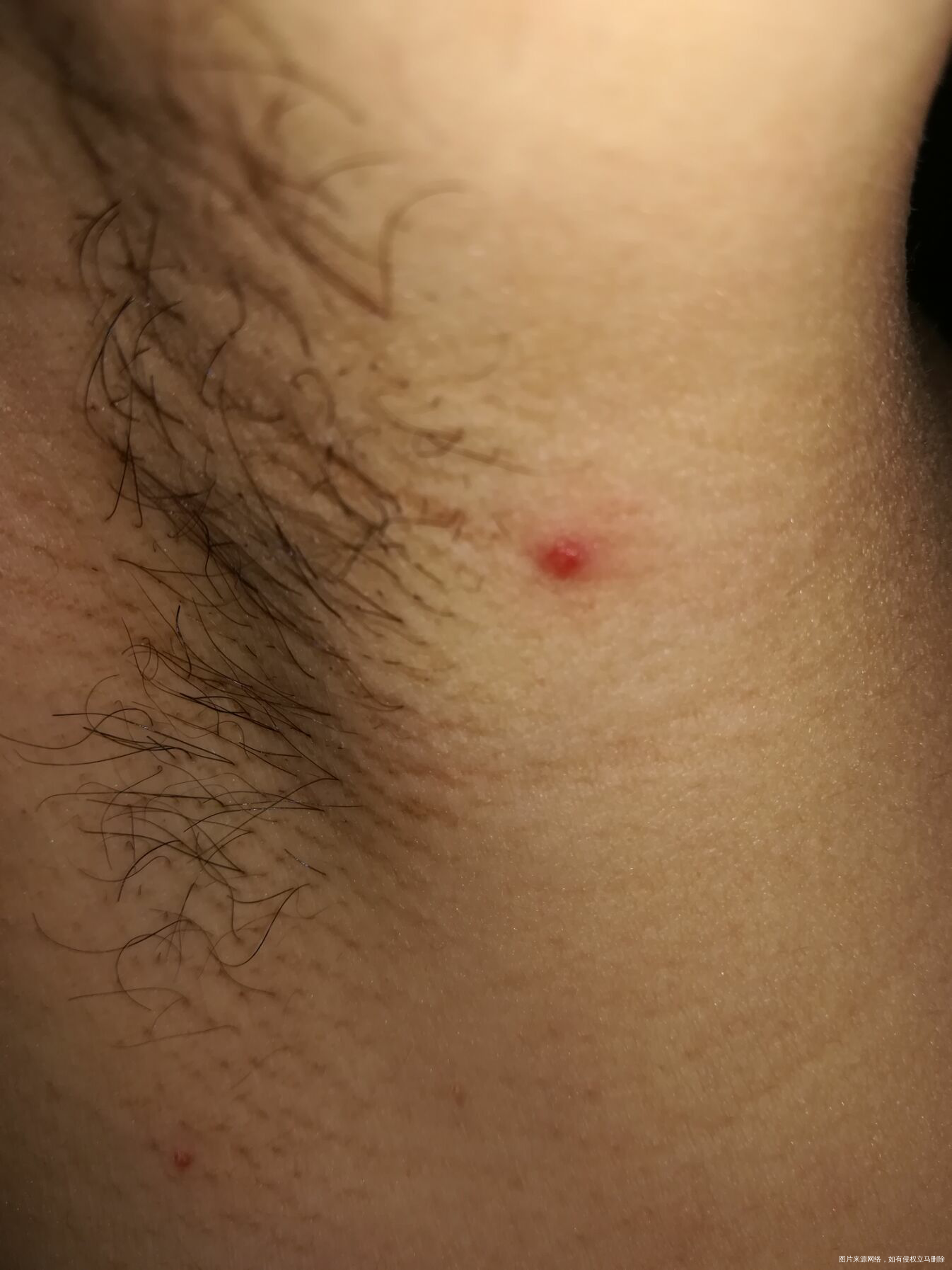 产后腋窝下有疙瘩,是怎么回事