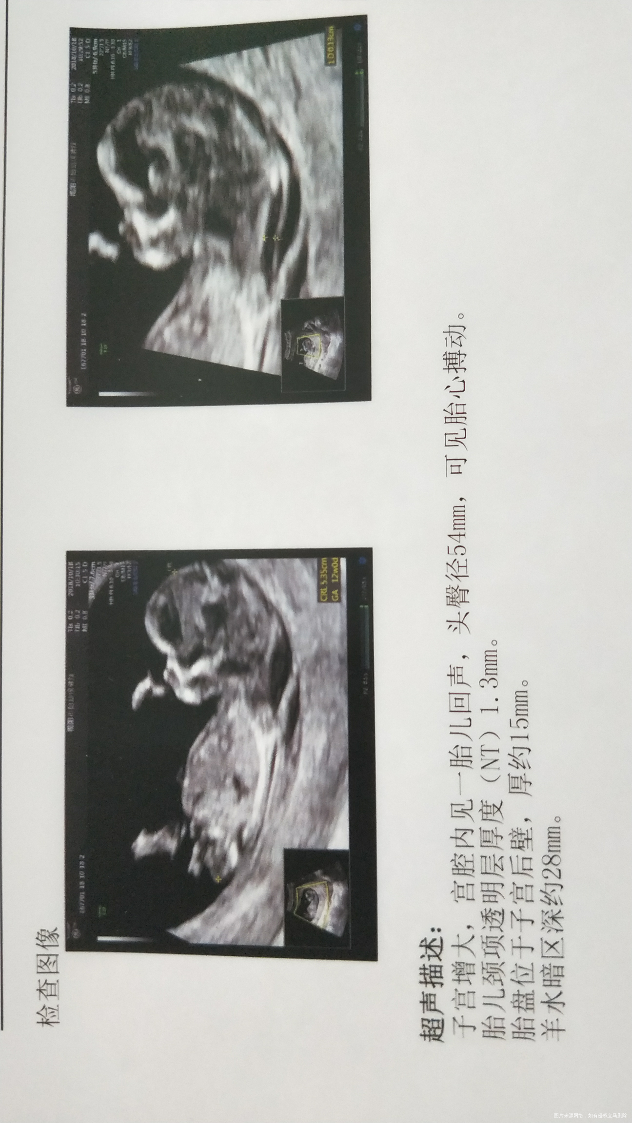 宝妈们,12周能看出性别吗?