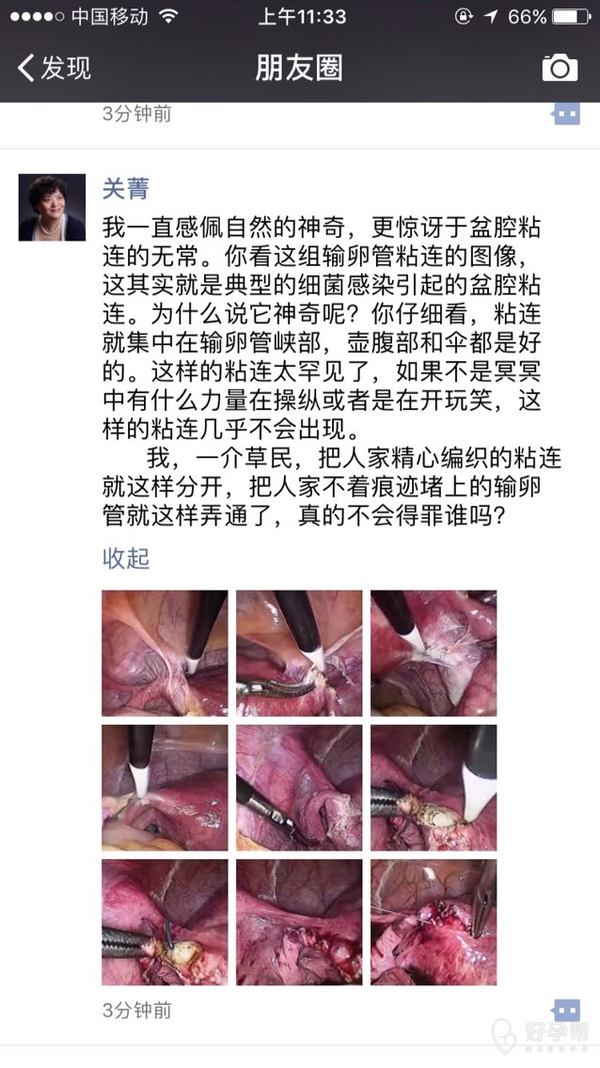 盆腔粘连连累了输卵管