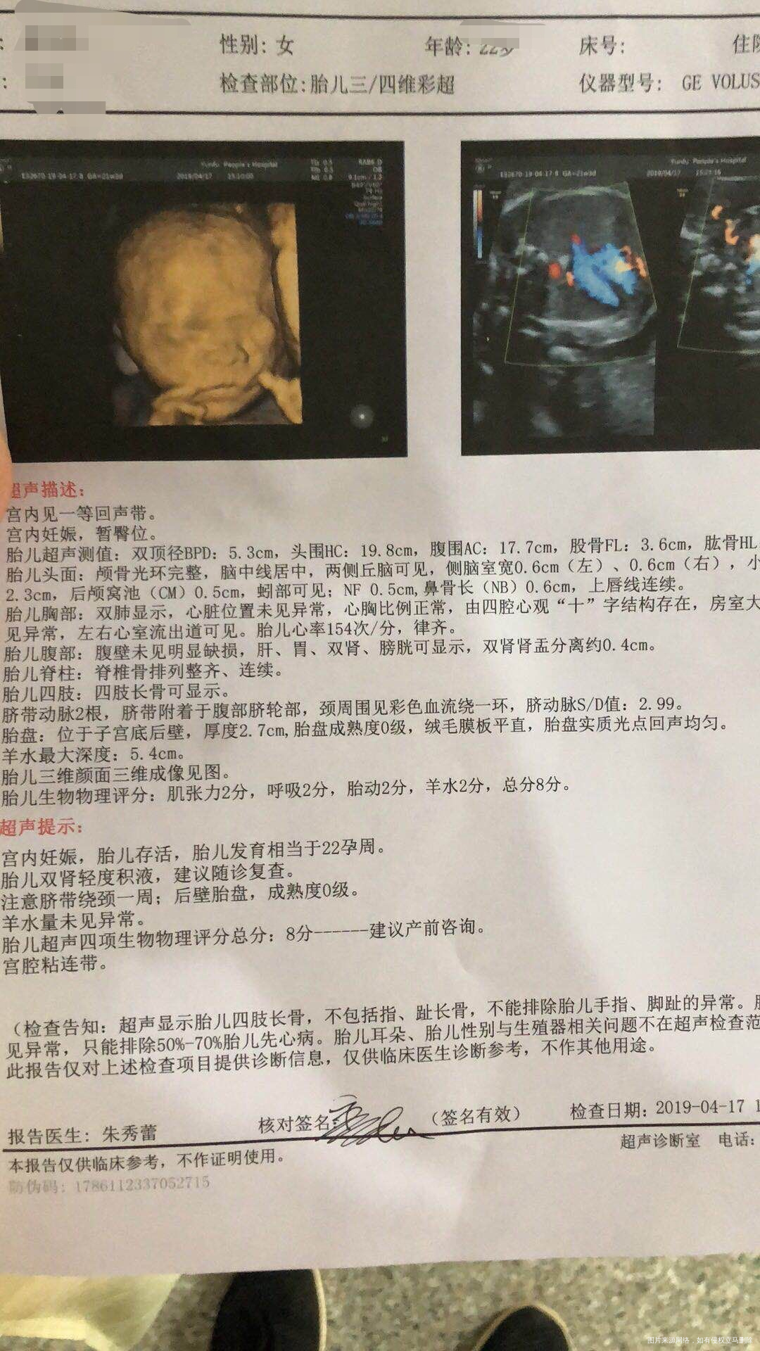 孕22周檢查出雙腎有積液、嚴重嗎?