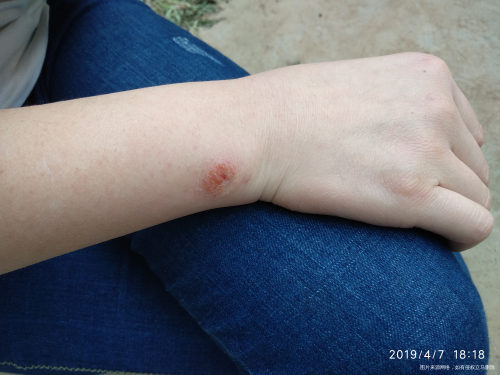 手腕挠破了后结痂,麻烦医生看看,感谢。