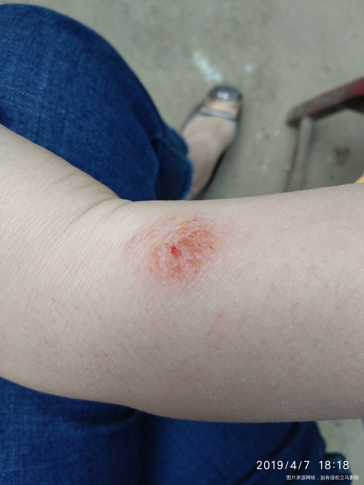 手腕挠破了后结痂,麻烦医生看看,感谢。