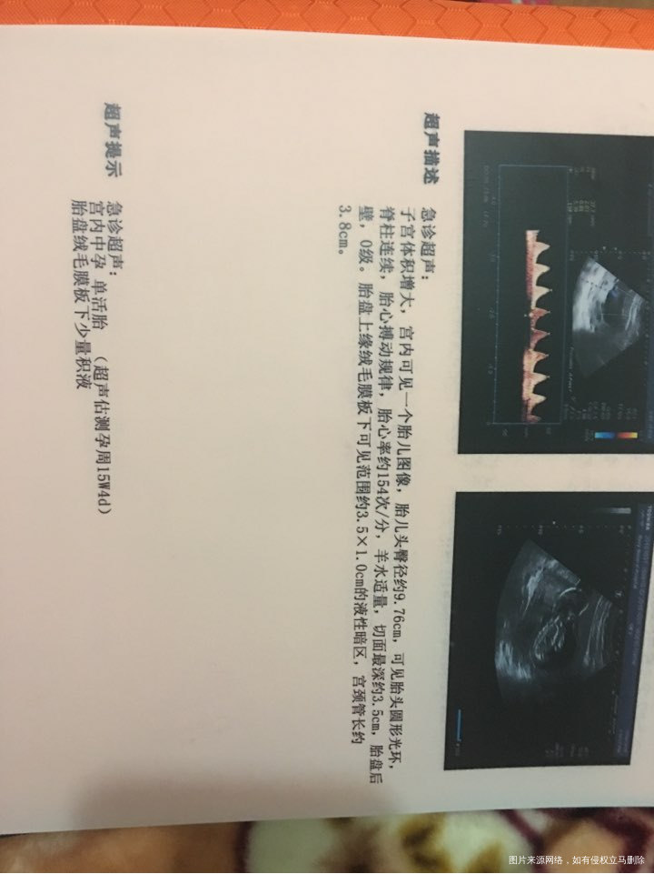 胎盘上缘绒毛膜板下少量积液