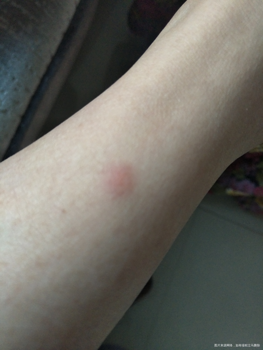 怀孕了身上长了这样的怎么办?