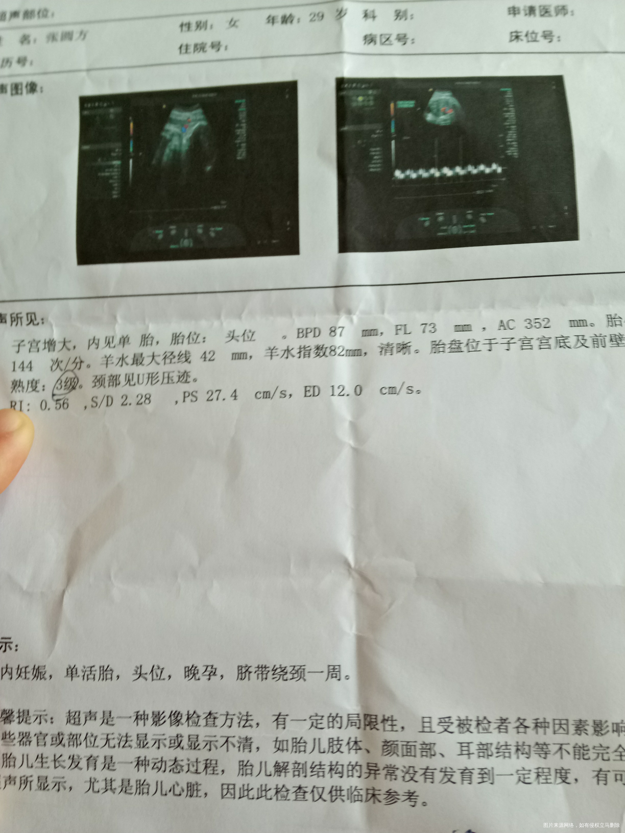 医生在线吗帮我看看单子胎盘老化了还有羊水少要住院吗39周了