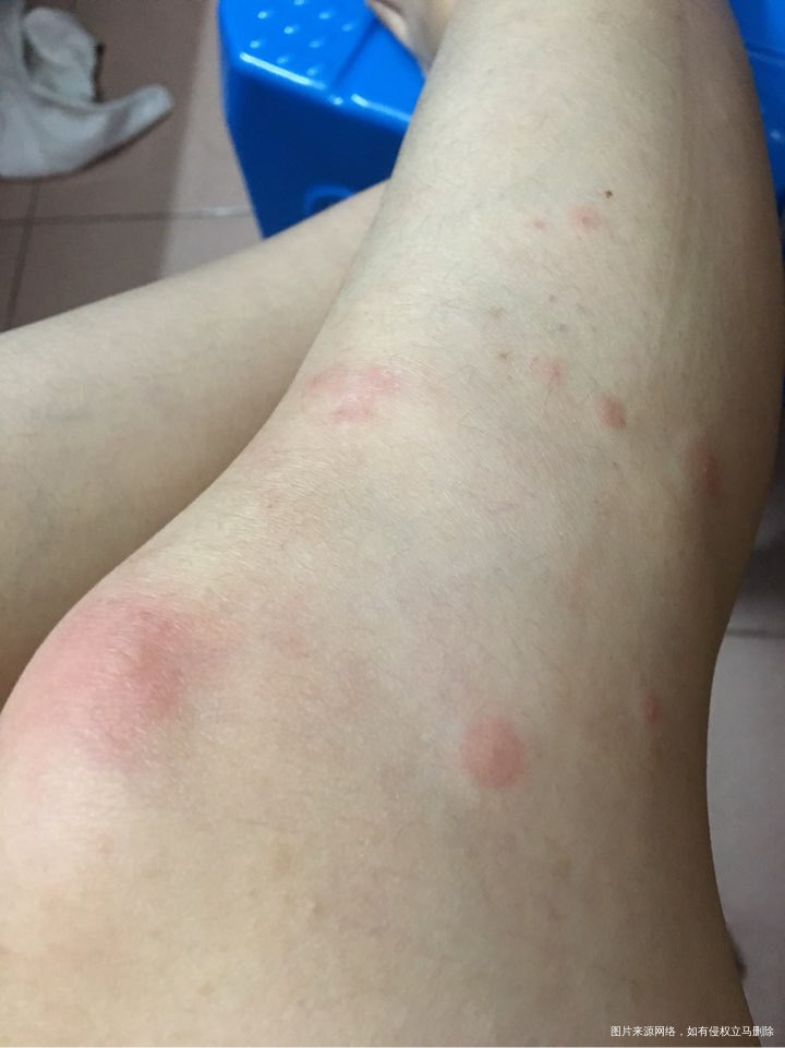 请问这是寻麻疹还是风疹