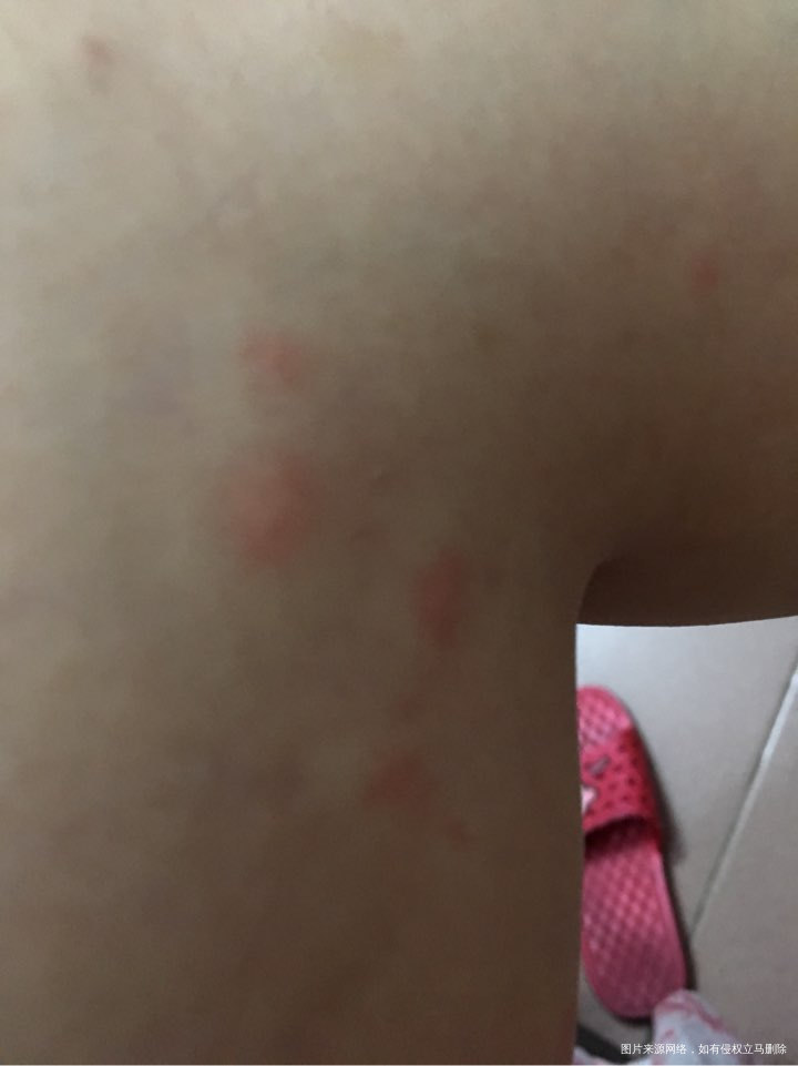 请问这是寻麻疹还是风疹