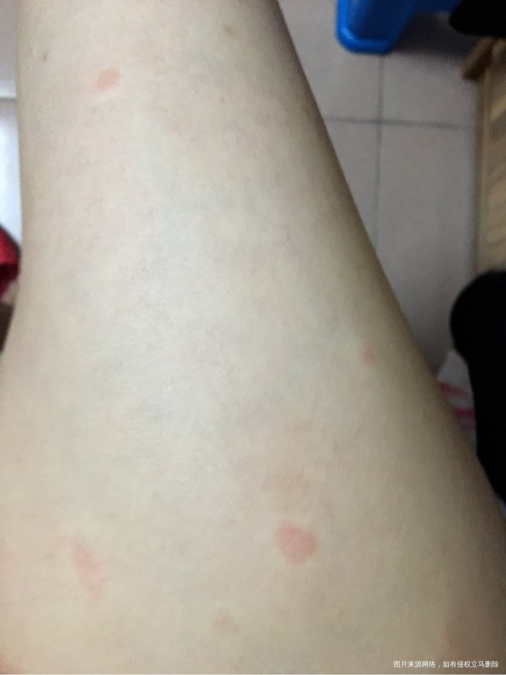 请问这是寻麻疹还是风疹