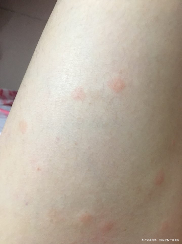 请问这是寻麻疹还是风疹