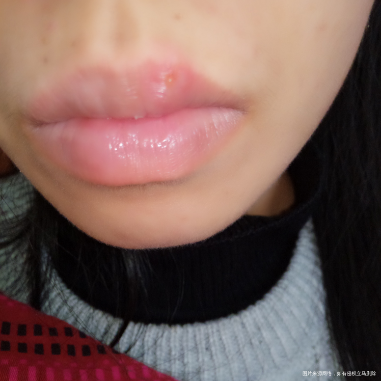 怀孕期间嘴唇又肿又痛,应该怎么用药?