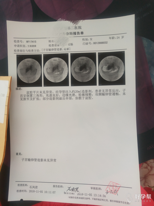 检查输卵管 希望能帮到大家 一起交流啊我是上举