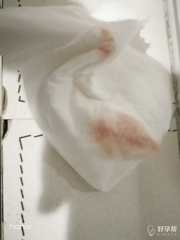 刚查出怀孕,孕35天,今天晚上上厕所有点出血,能帮忙看看是怎么回事吗?