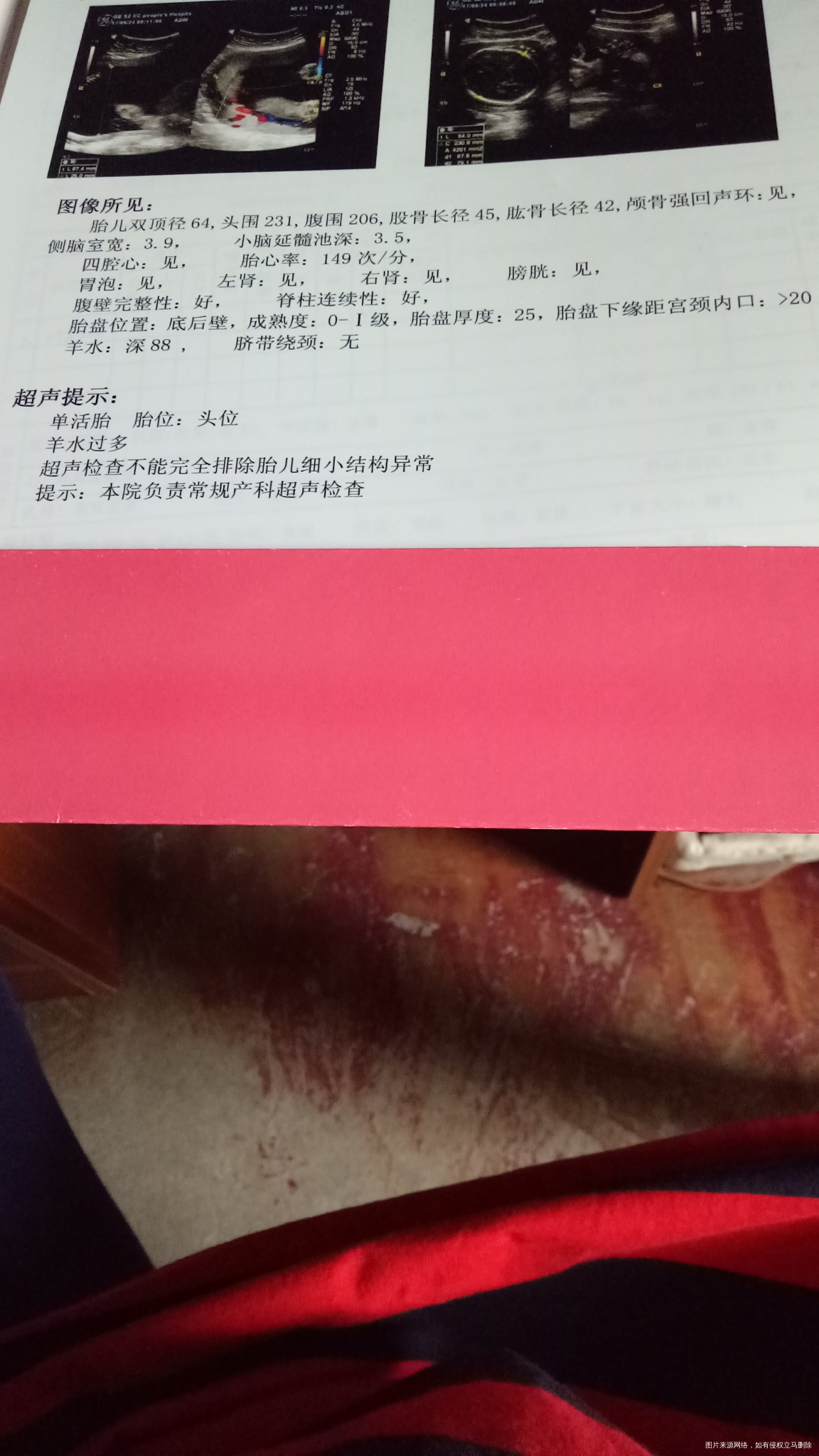 羊水有点多会不会有问题(O_O)?