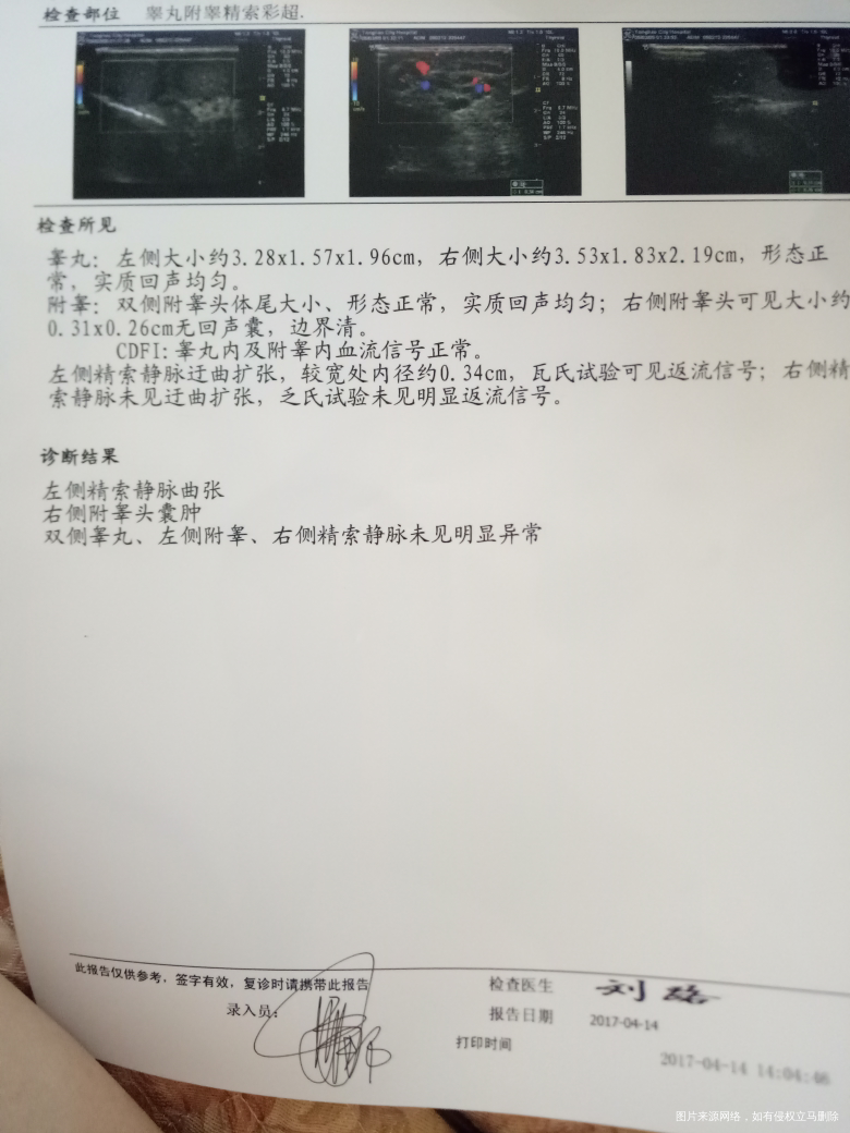 左侧精索静脉曲张必须得手术吗?