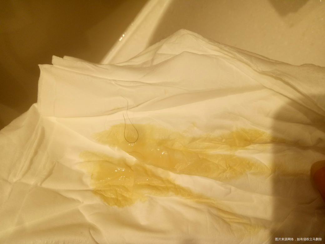 月经干净第一天,白带这样的,是什么问题?