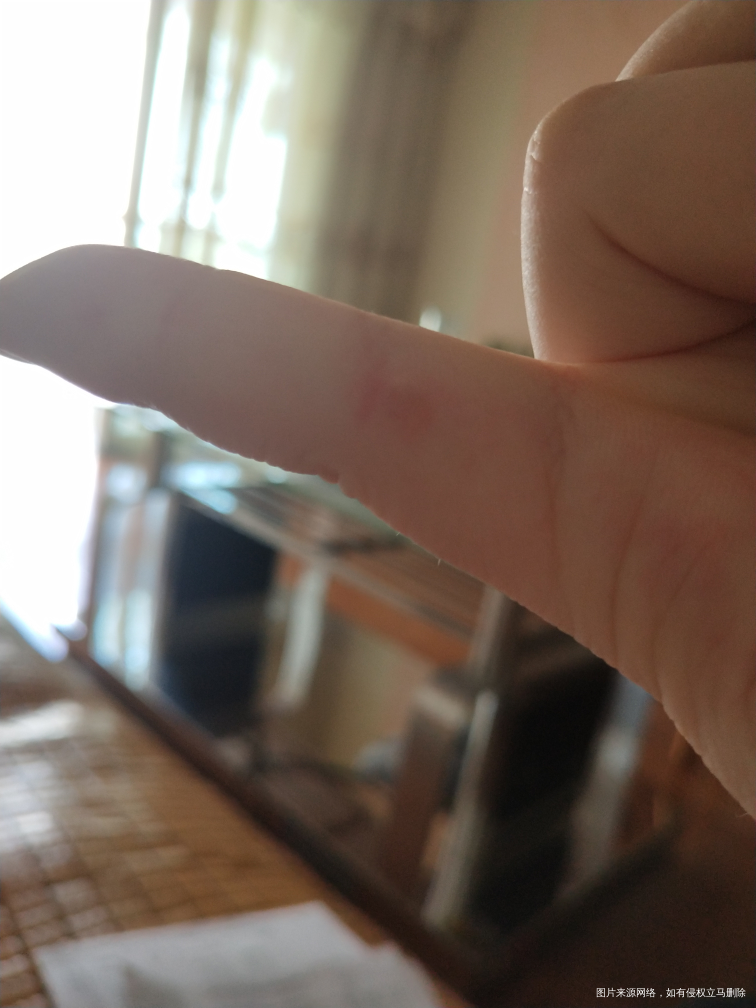 孕17周5天,请问这个到底是不是病毒性疱疹