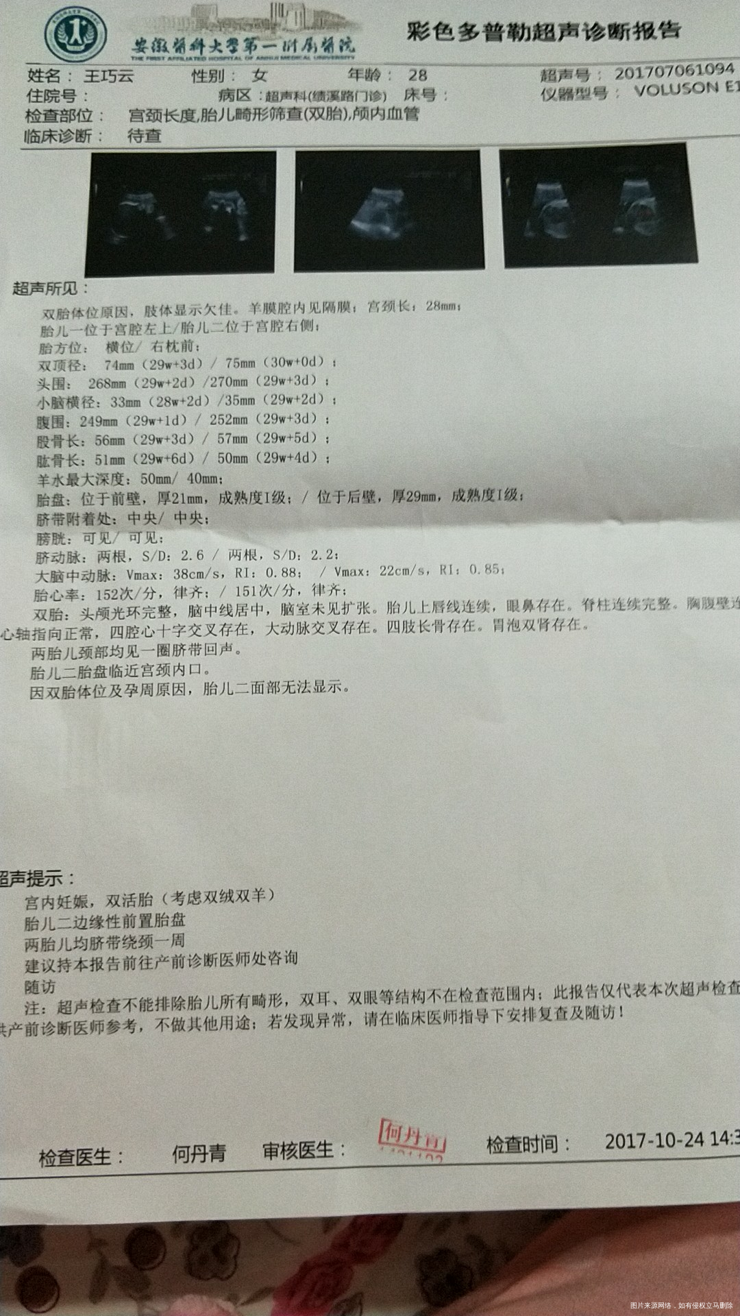 医生麻烦帮忙看下小脑横径偏小吗?