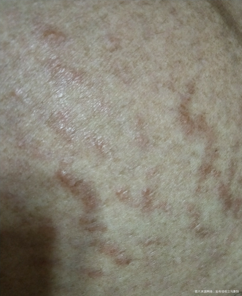 36+4肚皮上妊娠纹地方长小疙瘩非常痒