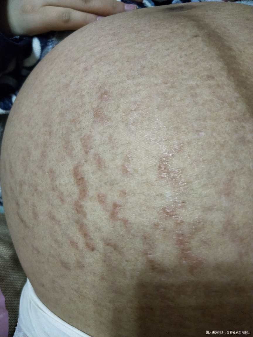 36+4肚皮上妊娠纹地方长小疙瘩非常痒