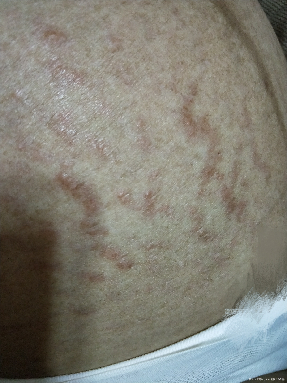 36+4肚皮上妊娠纹地方长小疙瘩非常痒